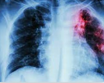 Fibrose Pulmonaire Présentation et Solution