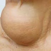 Comment Soigner Goitre Naturellement