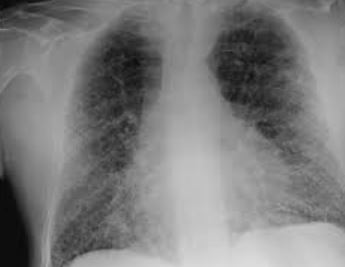 Qu'est ce qu'une fibrose