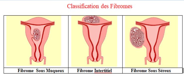 Fibrome et Myome : Comment Éliminer les Myomes Utérins