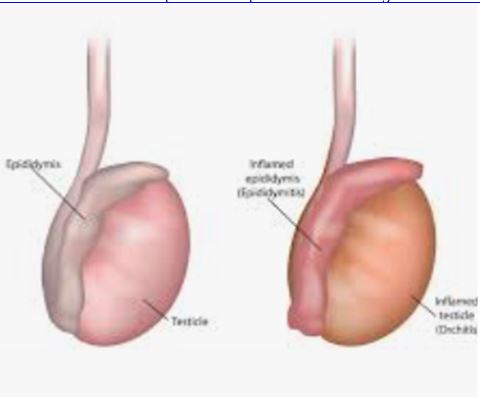L'Epididymite Soin Naturel