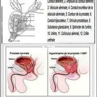 Traitement Naturel Prostatite