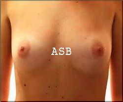 Cancer de Sein Solution Naturel
