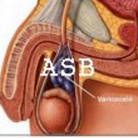 Comment Traiter La varicocèle