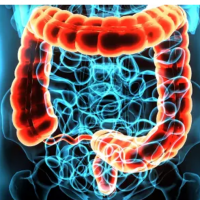 Polypes Intestinaux Remède Naturel Polype du Colon