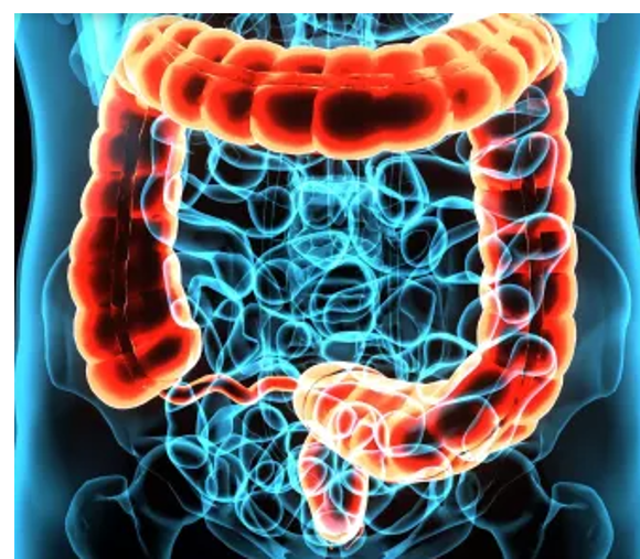 Polypes Intestinaux Remède Naturel Polype du Colon